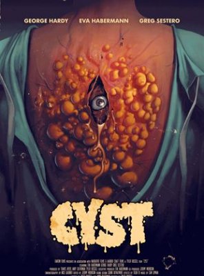 Cyst